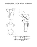 Adjustable bone plate fixation system and metho diagram and image