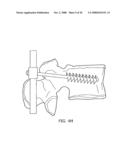 Adjustable bone plate fixation system and metho diagram and image