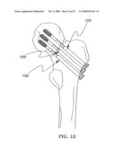 Adjustable bone plate fixation system and metho diagram and image