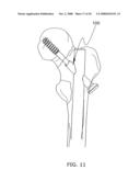 Adjustable bone plate fixation system and metho diagram and image