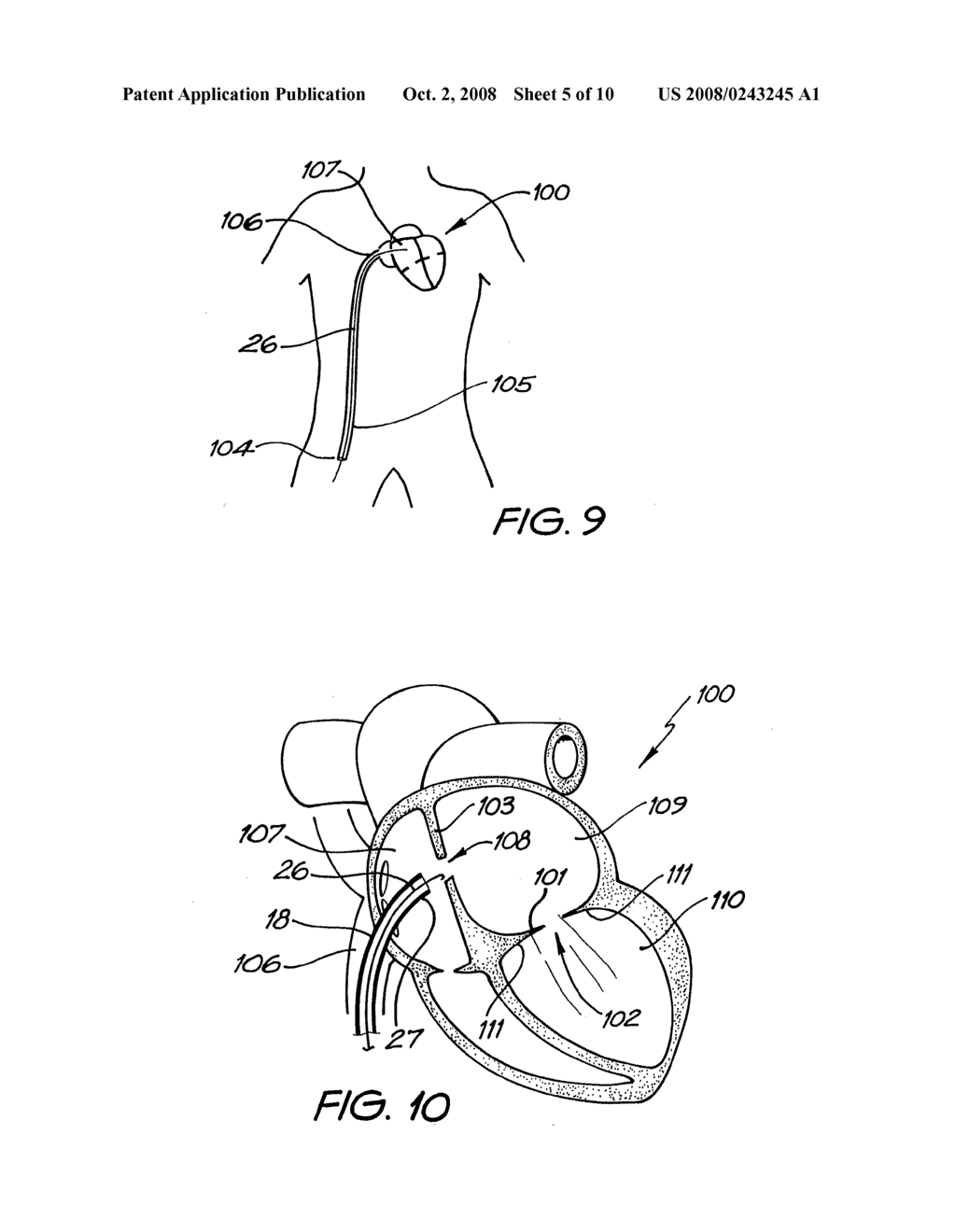 Percutaneous Heart Valve Prosthesis - diagram, schematic, and image 06