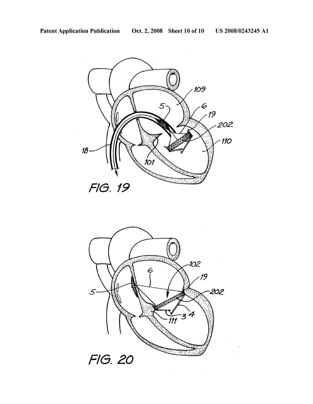 Percutaneous Heart Valve Prosthesis - diagram, schematic, and image 11