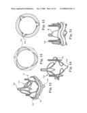 Replacement prosthetic heart valves and methods of implantation diagram and image