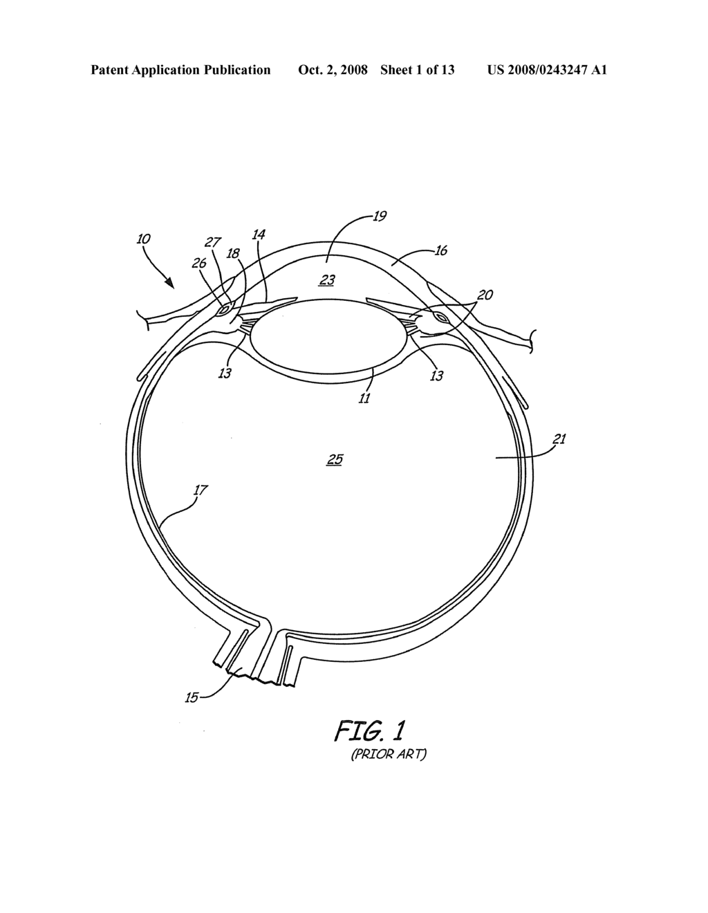 METHOD AND APPARATUS FOR PREVENTION AND TREATMENT OF ADULT GLAUCOMA - diagram, schematic, and image 02