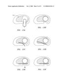 DEVICES USED TO TREAT DISC HERNIATION AND ATTACHMENT MECHANISMS THEREFORE diagram and image