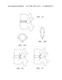 DEVICES USED TO TREAT DISC HERNIATION AND ATTACHMENT MECHANISMS THEREFORE diagram and image