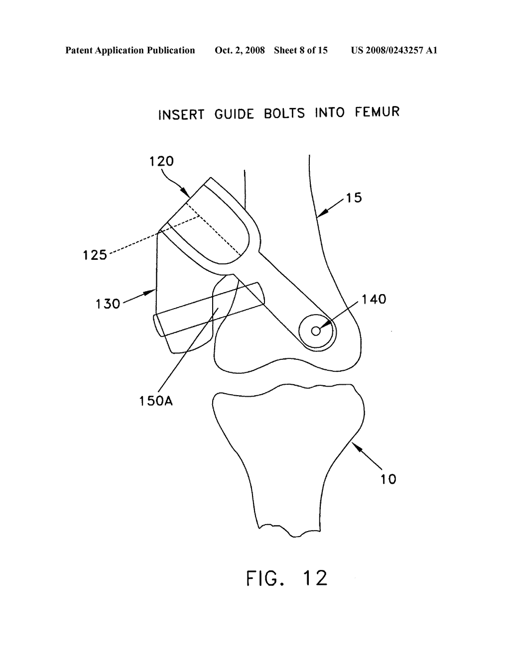 Method and apparatus for performing an open wedge, low femoral osteotomy - diagram, schematic, and image 09