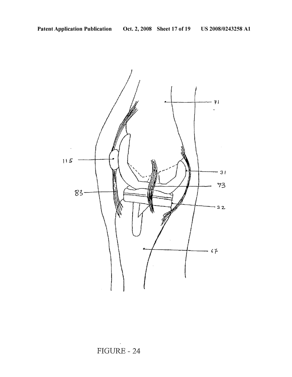 Knee Joint Prosthesis - diagram, schematic, and image 18