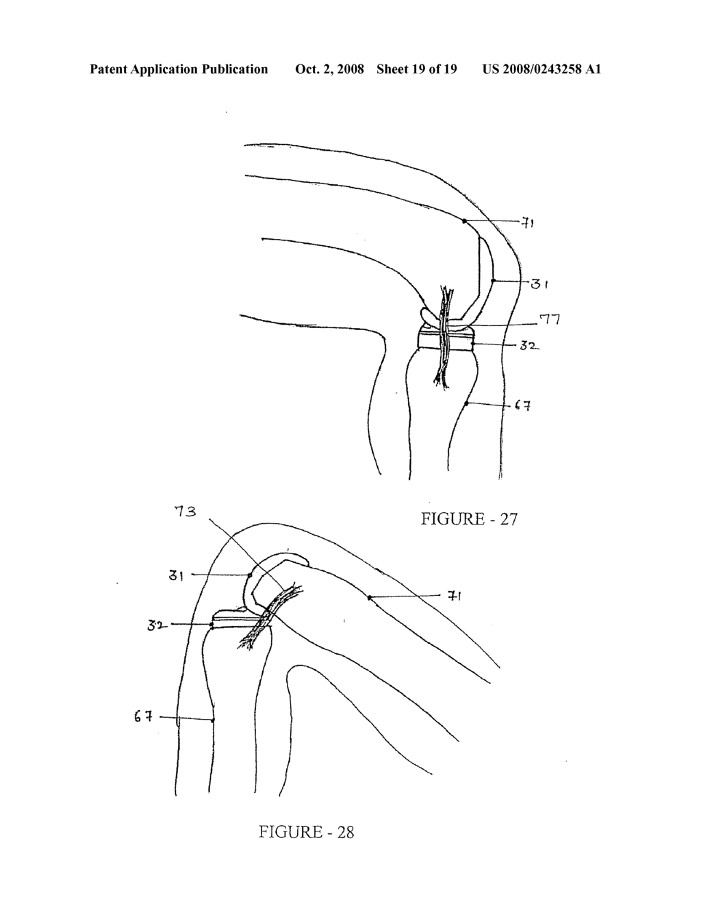 Knee Joint Prosthesis - diagram, schematic, and image 20