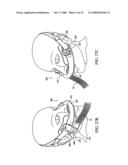 Patient Interface Device diagram and image