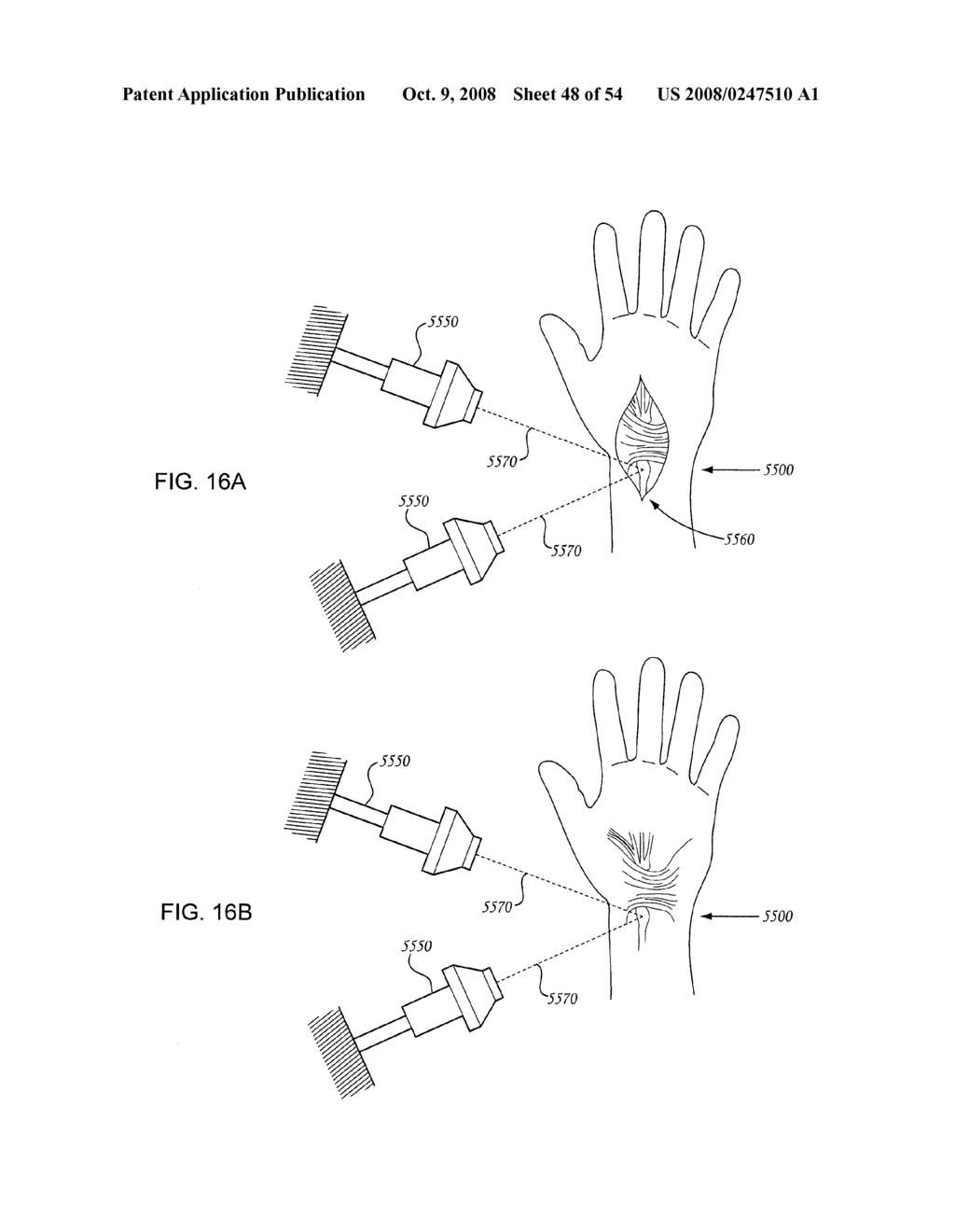 ORTHOVOLTAGE RADIOSURGERY - diagram, schematic, and image 49