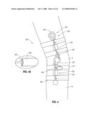 CABLE-BASED ORTHOPEDIC BRACING SYSTEM diagram and image