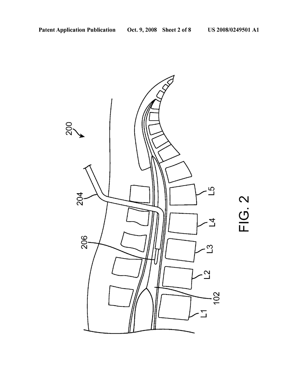 Methods for Simultaneous Injection and Aspiration of Fluids During a Medical Procedure - diagram, schematic, and image 03