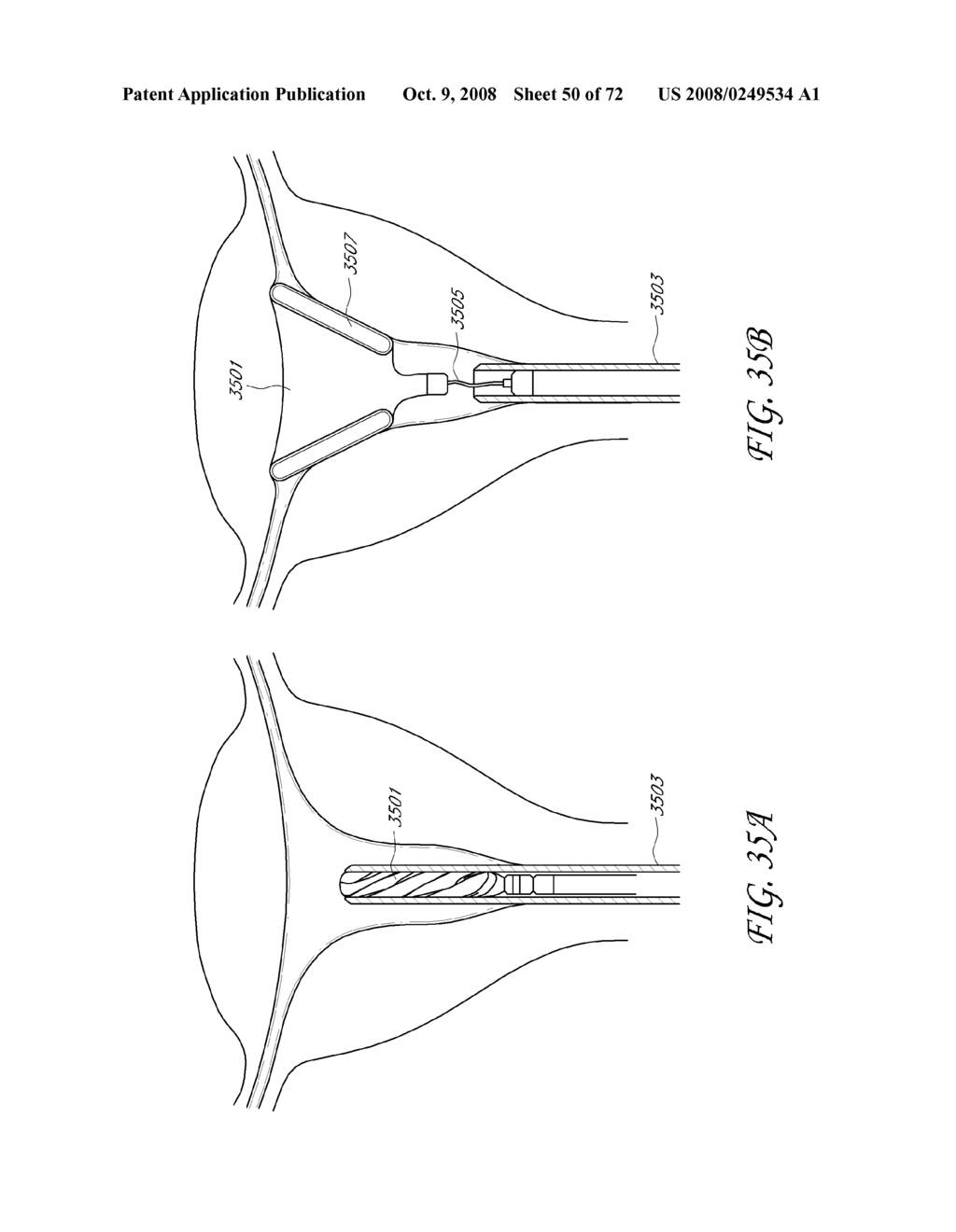 METHOD AND DEVICE FOR DISTENDING A GYNECOLOGICAL CAVITY - diagram, schematic, and image 51