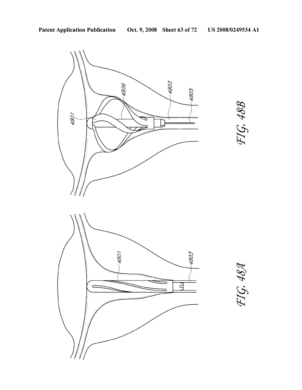 METHOD AND DEVICE FOR DISTENDING A GYNECOLOGICAL CAVITY - diagram, schematic, and image 64