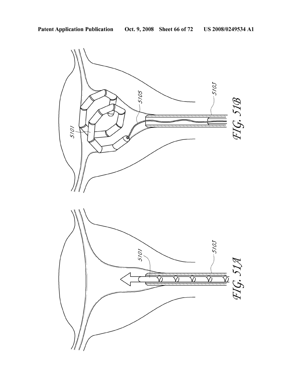 METHOD AND DEVICE FOR DISTENDING A GYNECOLOGICAL CAVITY - diagram, schematic, and image 67