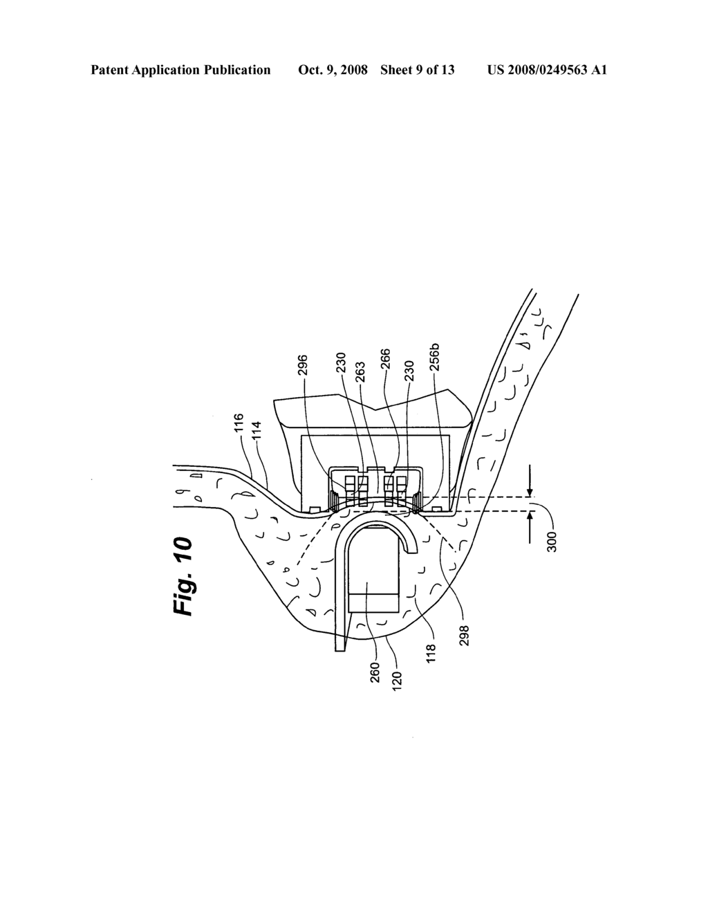 Method and apparatus for tissue fastening - diagram, schematic, and image 10