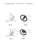 METHODS AND DEVICES FOR REDUCING GASTRIC VOLUME diagram and image