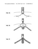 METHODS AND DEVICES FOR REDUCING GASTRIC VOLUME diagram and image