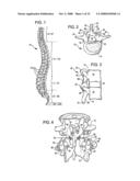 Crossbar Spinal Prosthesis Having a Modular Design and Systems for Treating Spinal Pathologies diagram and image