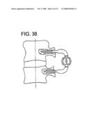 Crossbar Spinal Prosthesis Having a Modular Design and Systems for Treating Spinal Pathologies diagram and image