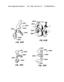 Crossbar Spinal Prosthesis Having a Modular Design and Systems for Treating Spinal Pathologies diagram and image