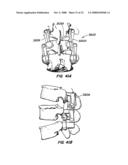 Crossbar Spinal Prosthesis Having a Modular Design and Systems for Treating Spinal Pathologies diagram and image