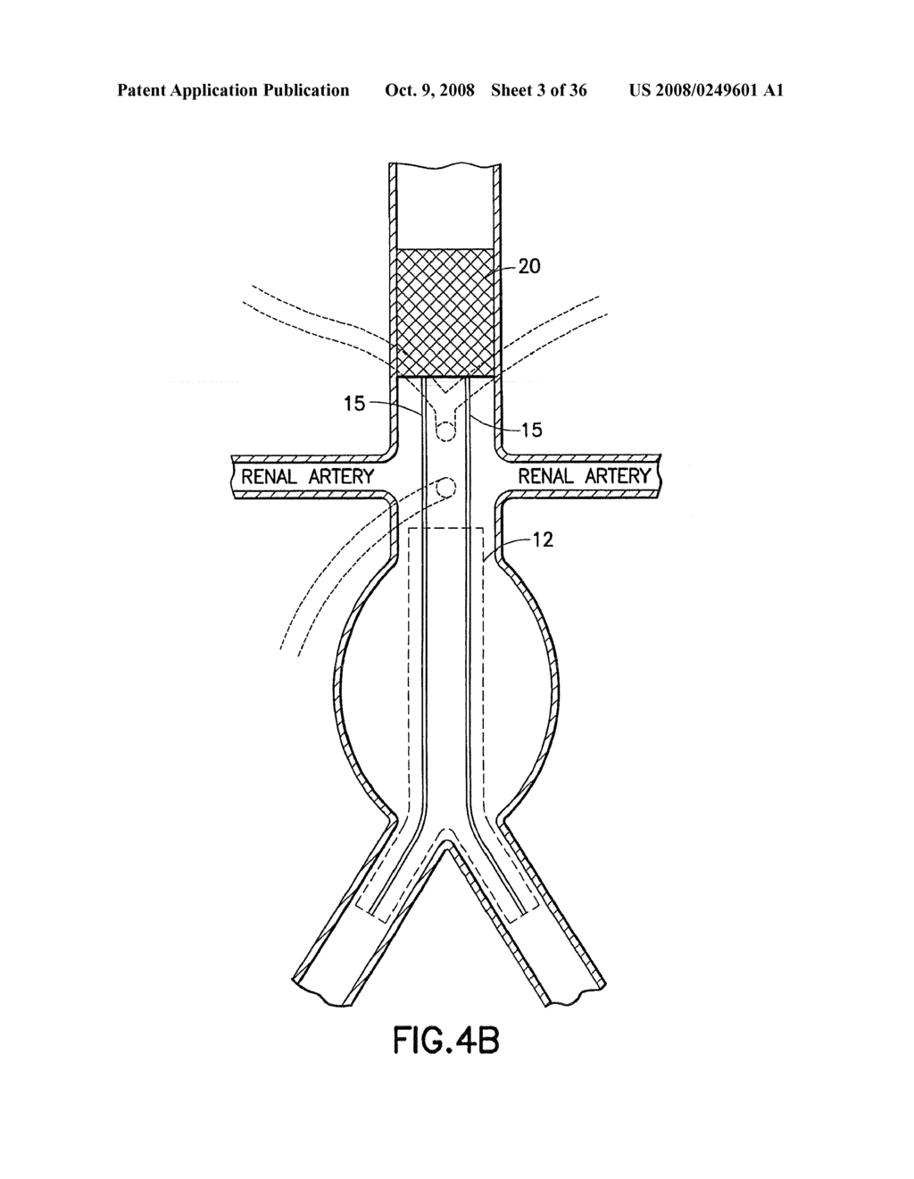 Stent/Graft Assembly - diagram, schematic, and image 04