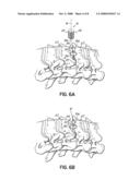 Prosthetic Disc Device and Method for Intervertebral Disc Replacement diagram and image