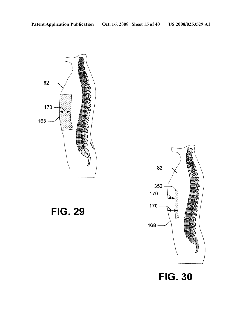 Ablating based at least partially on compton scattered x-ray visualizing, imaging, or information providing - diagram, schematic, and image 16