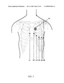 SYSTEM AND METHOD FOR DIAGNOSING AND TREATING LONG QT SYNDROME diagram and image