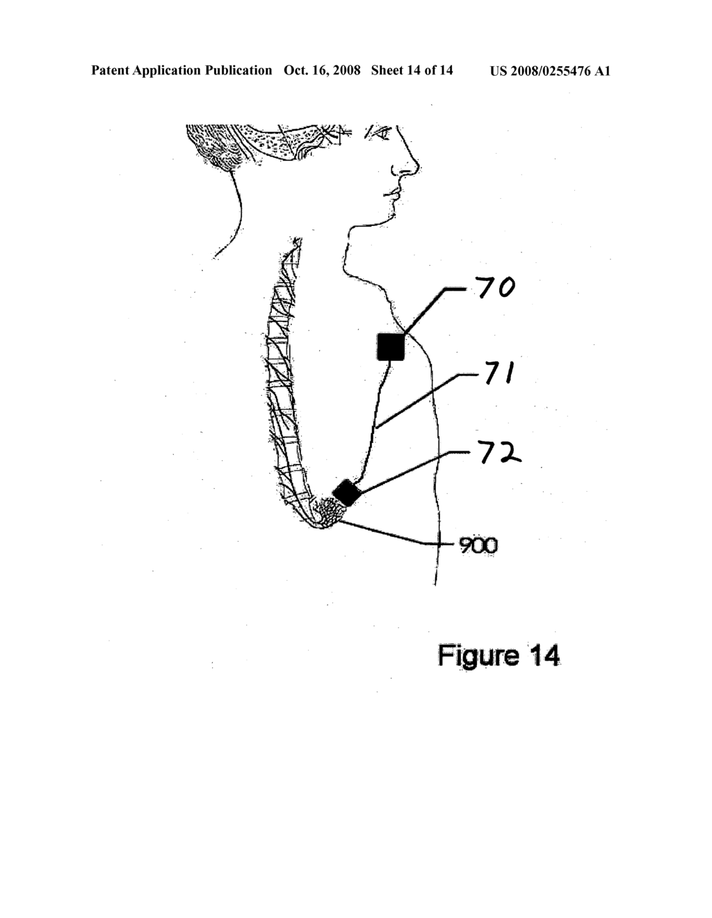 Methods and devices for treating obesity - diagram, schematic, and image 15