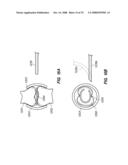 PERCUTANEOUS DELIVERY AND RETRIEVAL SYSTEMS FOR SHAPE-CHANGING ORTHOPEDIC JOINT DEVICES diagram and image