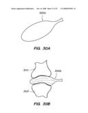 PERCUTANEOUS DELIVERY AND RETRIEVAL SYSTEMS FOR SHAPE-CHANGING ORTHOPEDIC JOINT DEVICES diagram and image