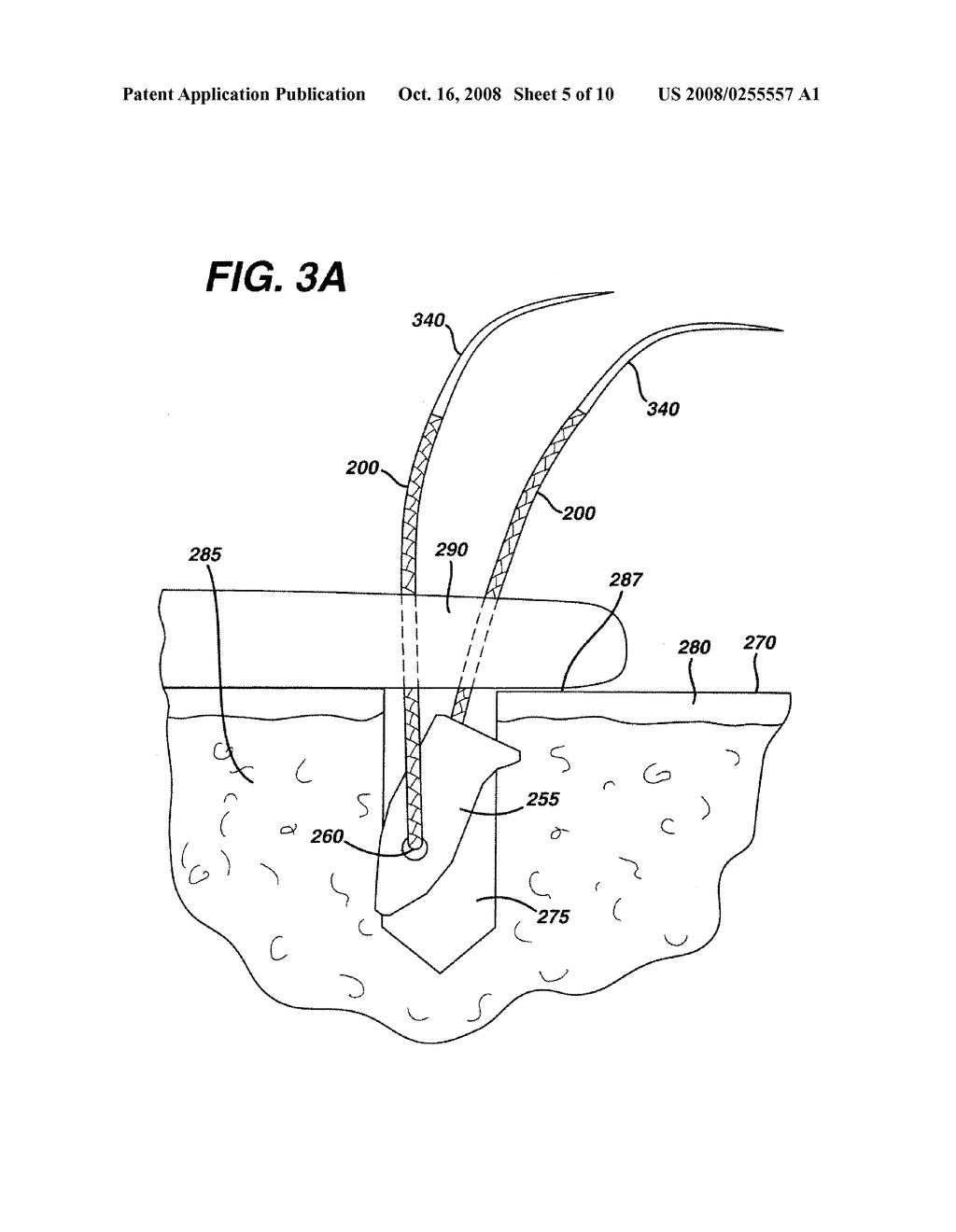 HIGH STRENGTH SUTURE WITH ABSORBABLE CORE AND SUTURE ANCHOR COMBINATION - diagram, schematic, and image 06