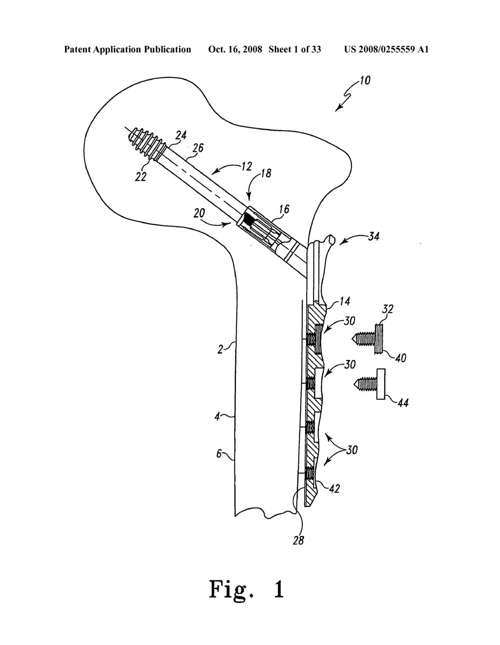 Orthopaedic trauma hip screw assembly and associated method - diagram, schematic, and image 02