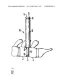 Bone cutting device diagram and image