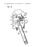 Bone cutting device diagram and image