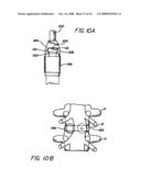 Bone cutting device diagram and image