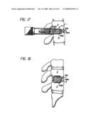 Bone cutting device diagram and image