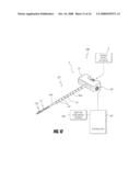 BONE TREATMENT SYSTEMS AND METHODS diagram and image