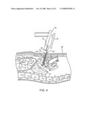 Resiliently deformable tool guide for use in minimally invasive telesurgical system diagram and image