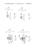 Apparatus and method for remote deflation of intragastric balloon diagram and image