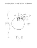 Apparatus and method for remote deflation of intragastric balloon diagram and image