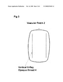 LABELED VASCULAR PATCH diagram and image