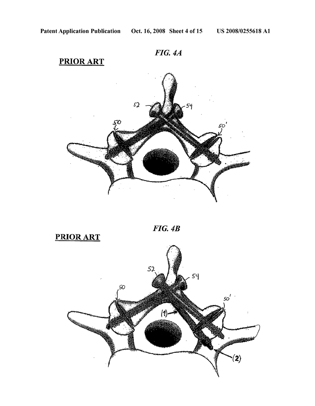 ARTICULATING FACET FUSION SCREW - diagram, schematic, and image 05