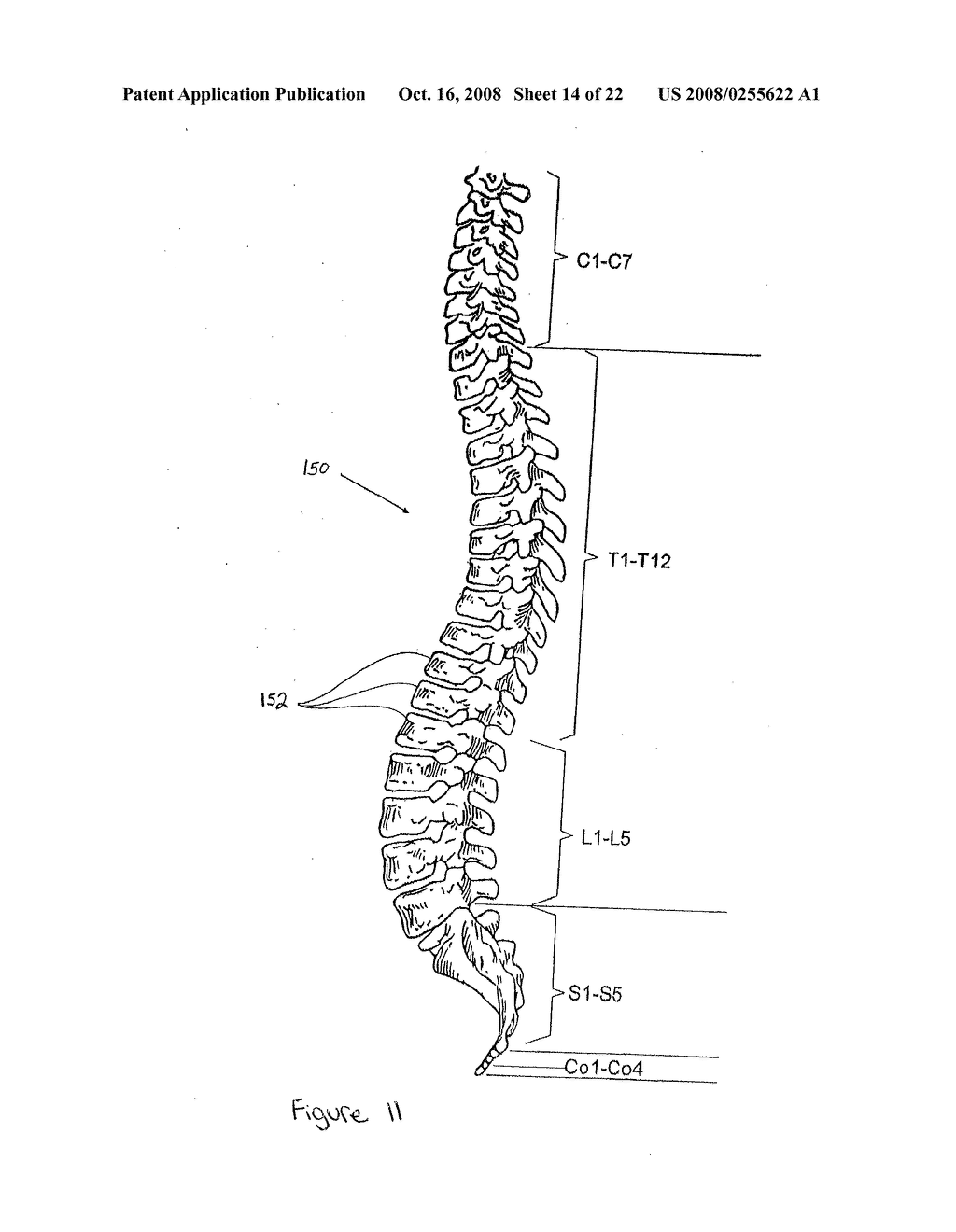 FACET FIXATION AND FUSION SCREW AND WASHER ASSEMBLY AND METHOD OF USE - diagram, schematic, and image 15