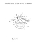 FACET FIXATION AND FUSION SCREW AND WASHER ASSEMBLY AND METHOD OF USE diagram and image