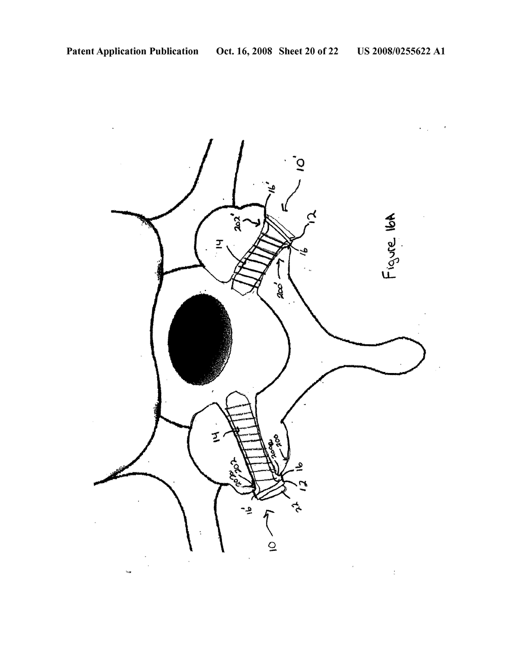 FACET FIXATION AND FUSION SCREW AND WASHER ASSEMBLY AND METHOD OF USE - diagram, schematic, and image 21