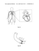 Medical device for treating a heart valve insufficiency or stenosis diagram and image